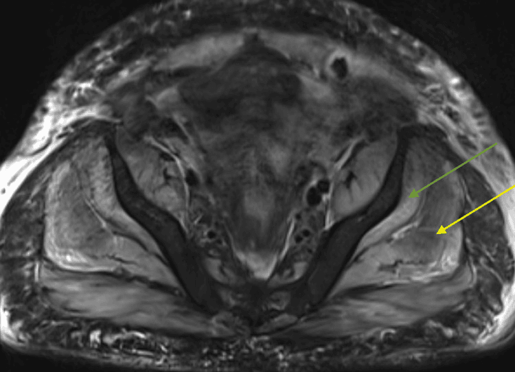 Pelvic MRI showing gluteal muscle edema in statin associated myopathy