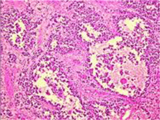 Single-panel H&E of the alveolar classification subtype of rhabdomyosarcoma showing a monomorphic proliferation of small round cells with a high nuclear-to-cytoplasmic ratio