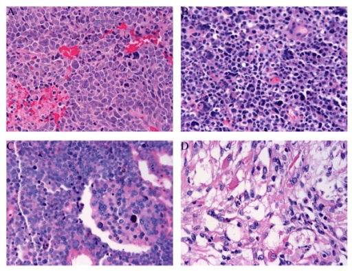 Four-panel H&E photomicrograph illustrating the histological classification and subtypes of rhabdomyosarcoma, showing small round blue cells with focal eosinophilic rhabdomyoblastic differentiation