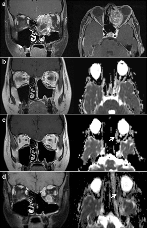 Multi-panel MRI and fused PET-CT of a left-orbital rhabdomyosarcoma showing an orbital soft tissue mass at diagnosis and follow-up
