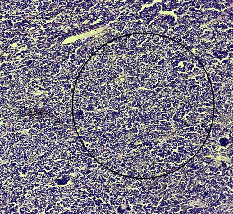 Low-power haematoxylin and eosin section showing a highly cellular malignant neoplasm with alveolar architecture and fibrovascular septa