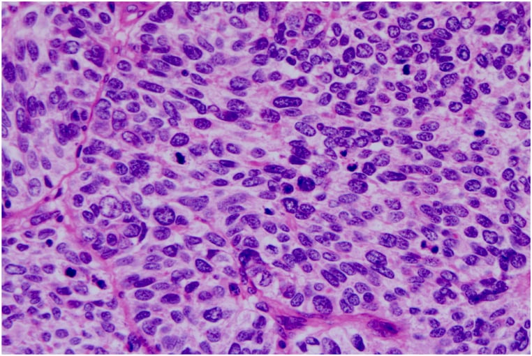 High-power haematoxylin and eosin section showing sheets of uniformly sized epithelioid tumour cells in an organoid nesting pattern