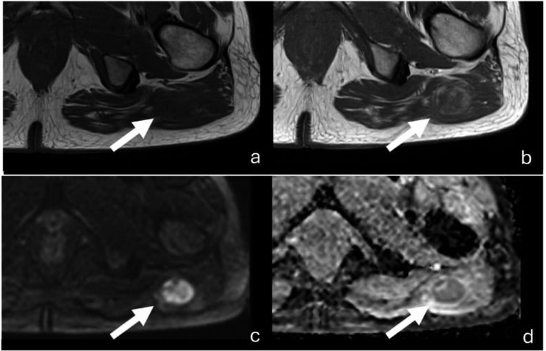 MRI of a soft-tissue sarcoma of the lower extremity illustrating the two guideline-recommended sequences most often omitted in practice