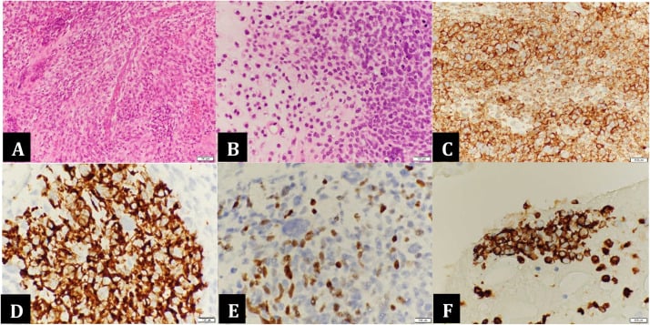 Panel showing haematoxylin and eosin sections of small round blue cells with immunohistochemistry demonstrating positive myogenic markers