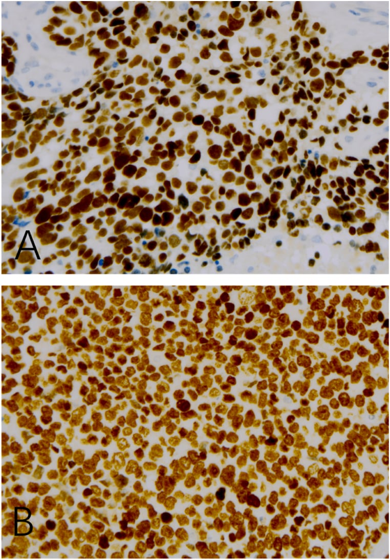 Immunohistochemistry showing diffuse strong nuclear positivity in tumour cells with two distinct antibody clones