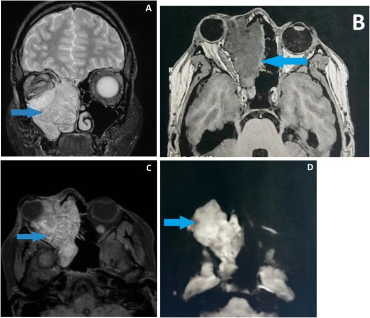 Head and neck MRI showing a large right maxillo-orbito-ethmoido-nasal mass measured on T1 and T2 sequences with the resected specimen