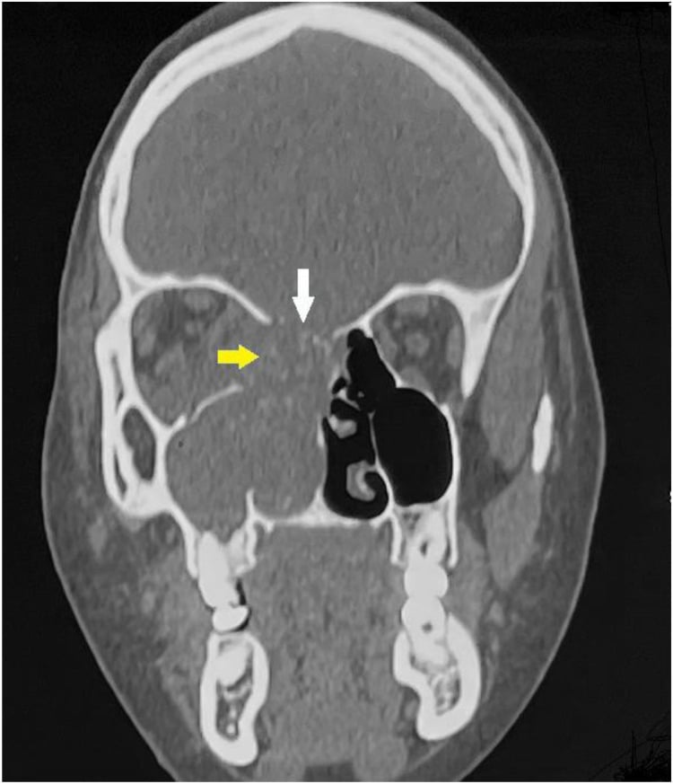Coronal bone-window contrast-enhanced CT showing a right ethmoido-maxillo-nasal mass with internal calcifications occupying the nasal cavity