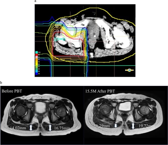 Proton beam therapy dose distribution with axial MRI before treatment and at fifteen months after, showing measured muscle thickness on irradiated and contralateral sides
