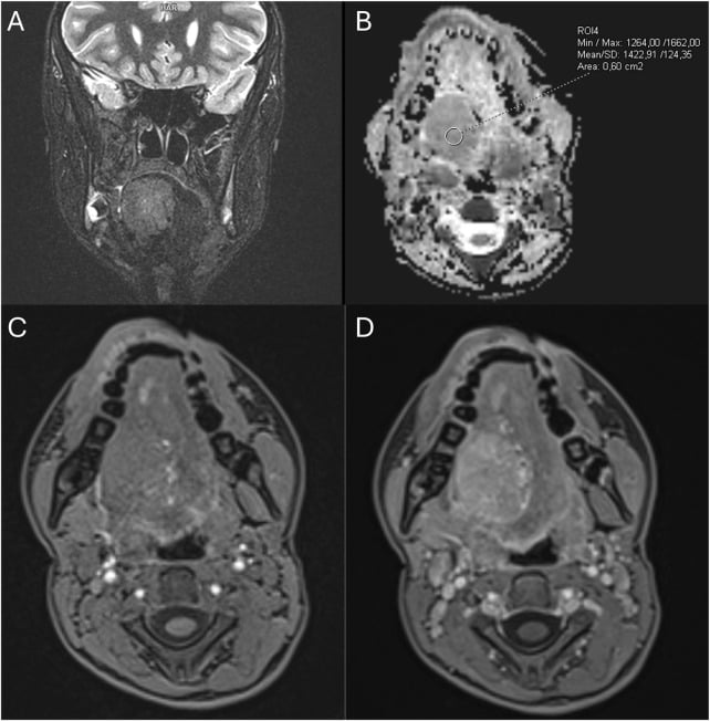 Coronal T2-weighted fat-saturated MRI and apparent diffusion coefficient map showing a pathological mass in the tongue