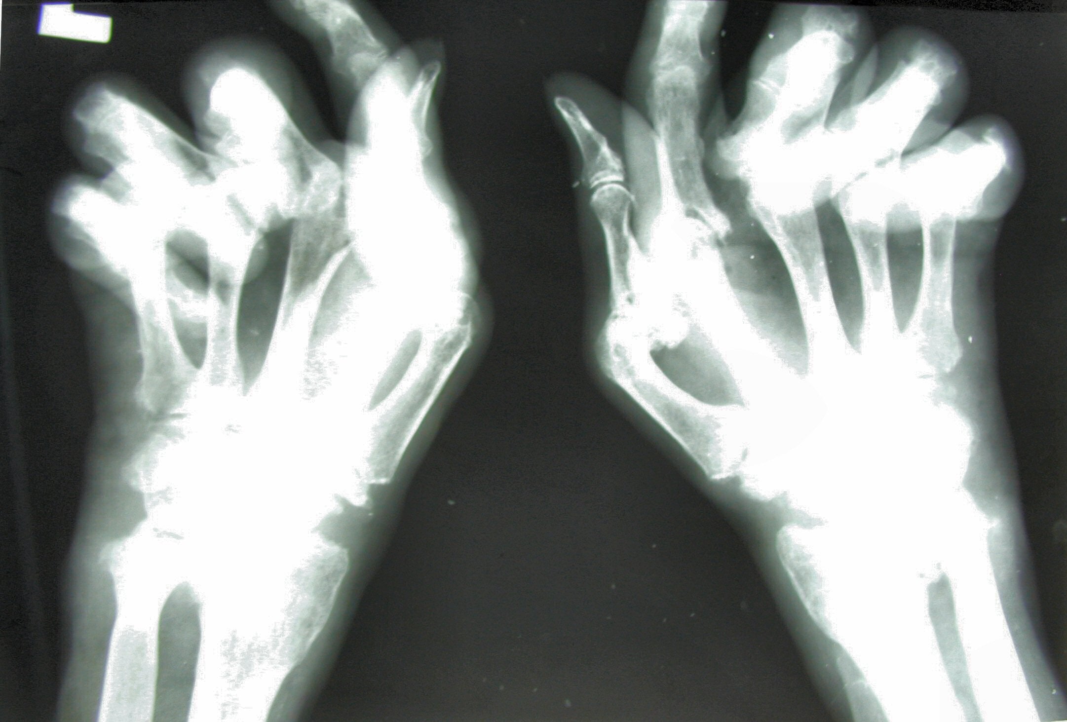 Bilateral hand radiograph of severe destructive rheumatoid arthritis.