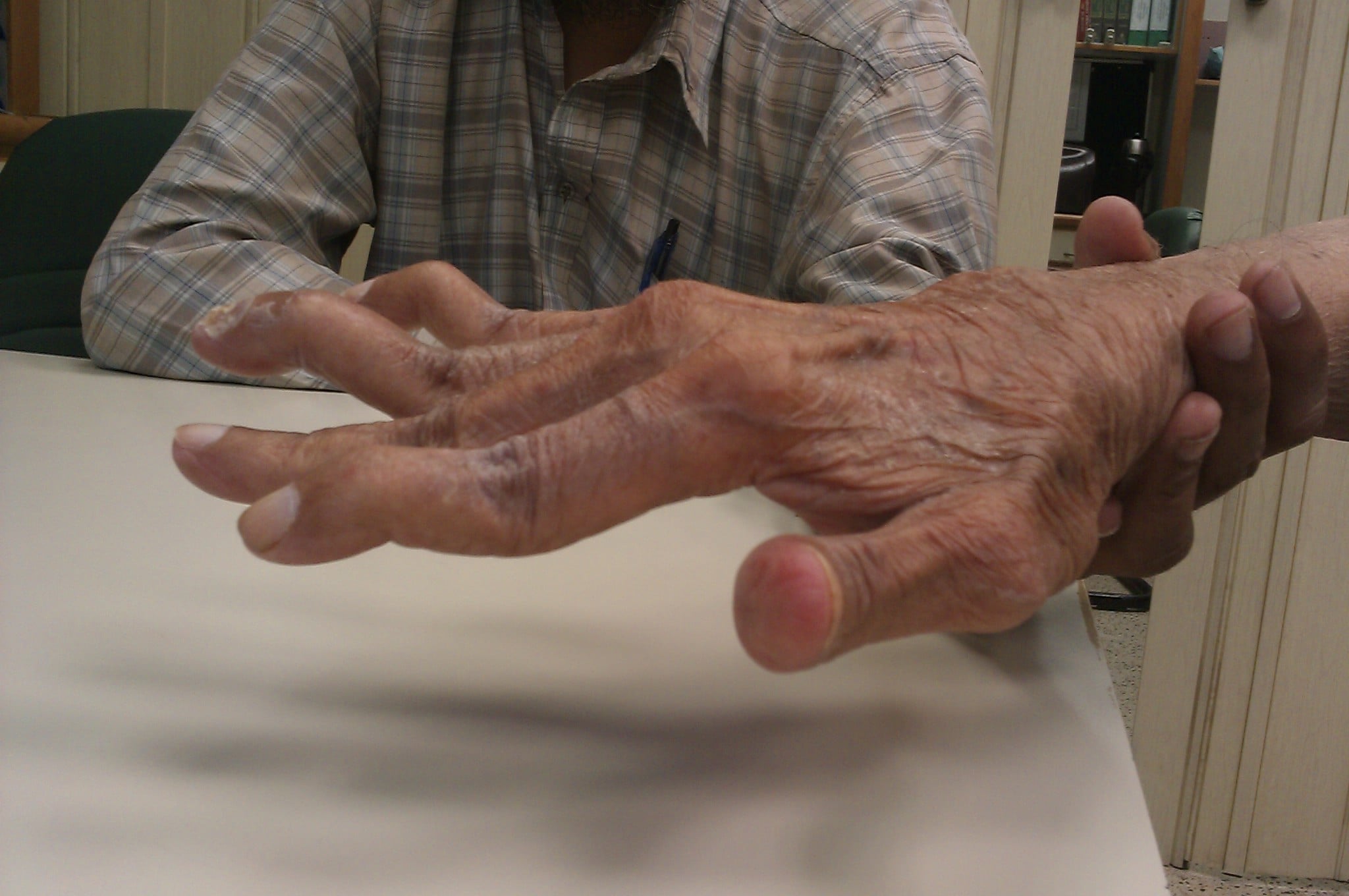 Clinical photograph of a rheumatoid hand with swan-neck deformities.