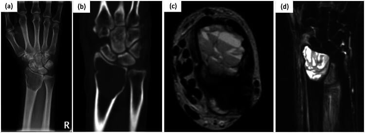 Radiograph and axial CT of the wrist showing distal radioulnar joint erosions in rheumatoid arthritis