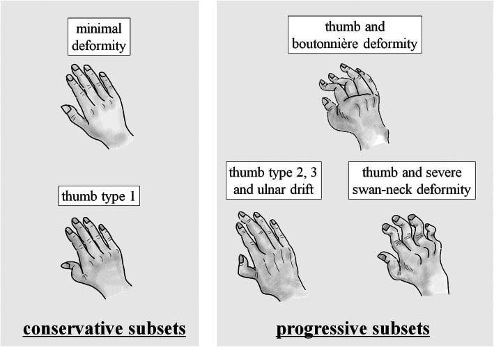 Schematic diagram of rheumatoid hand and thumb deformity classification patterns