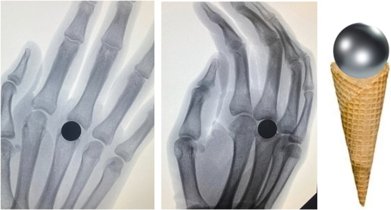 Intraoperative radiograph of silicone MCP joint arthroplasty in a rheumatoid hand