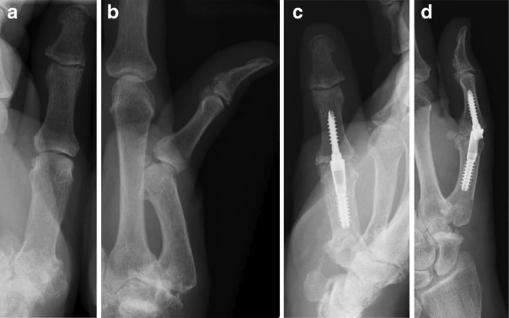 Preoperative and postoperative radiographs of thumb metacarpophalangeal joint arthrodesis