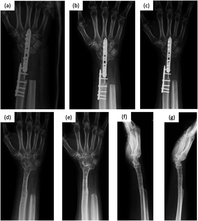 Postoperative radiographs showing total wrist arthrodesis with dorsal locking plate fixation