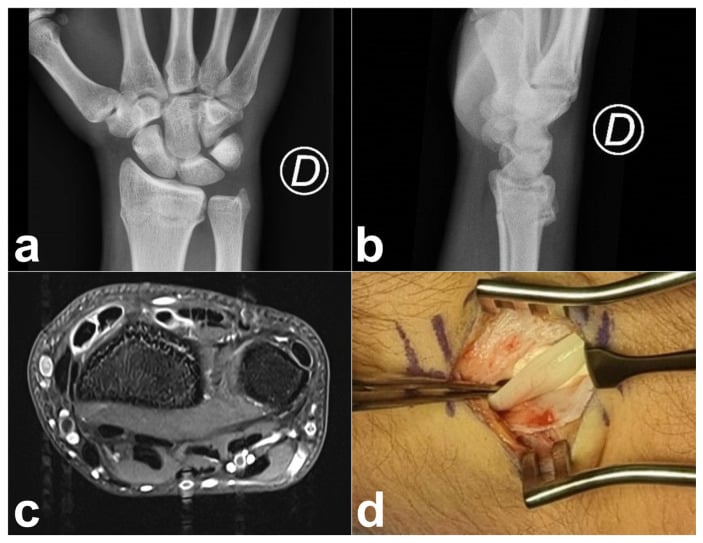 Imaging and clinical examination of extensor tendon rupture in a rheumatoid wrist