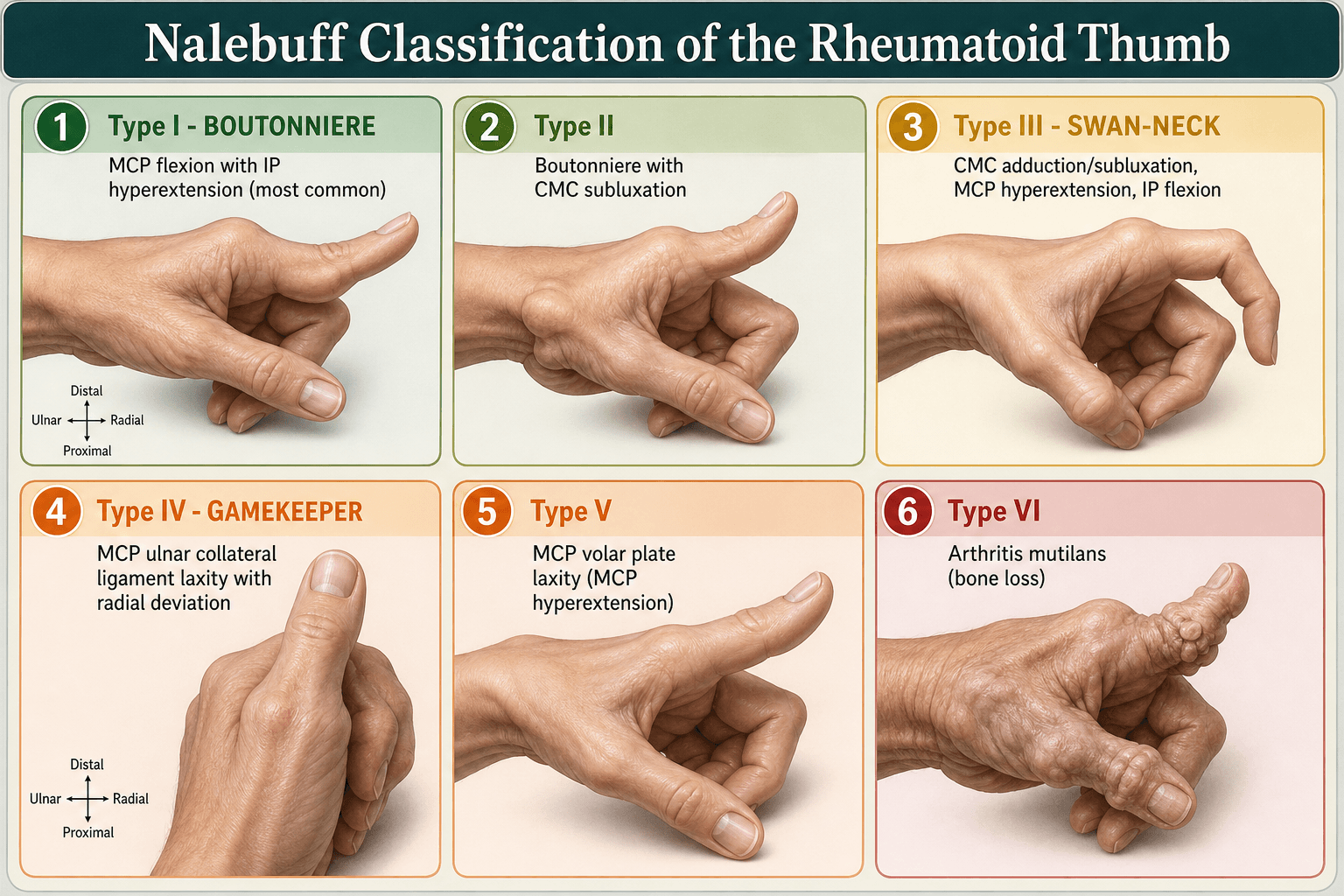Nalebuff classification of the rheumatoid thumb