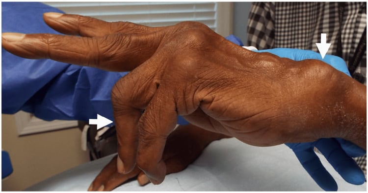 Clinical photograph showing loss of ring- and little-finger extension in Vaughan-Jackson syndrome with a prominent dorsally subluxated ulnar head.