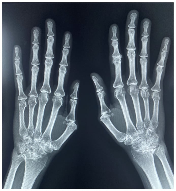 Frontal hand radiograph showing severe rheumatoid pancarpal joint-space loss and periarticular demineralisation with DIP sparing.