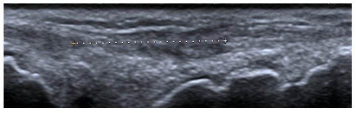 Long-axis ultrasound showing complete extensor digitorum tendon discontinuity at the wrist.