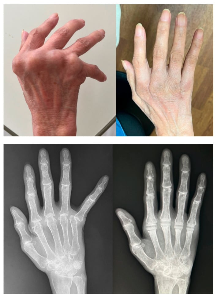 Preoperative and postoperative clinical photographs and radiographs of silicone MCP arthroplasty correcting rheumatoid ulnar drift.