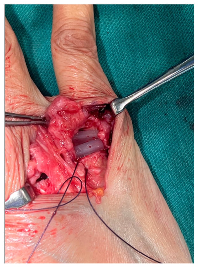 Intraoperative view of a silicone MCP implant seated with collateral-ligament sutures prepared for reconstruction.