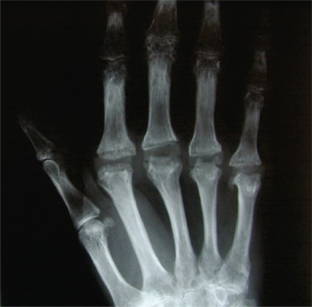 Postoperative hand radiograph showing aligned Swanson silastic MCP joint arthroplasties without implant fracture.