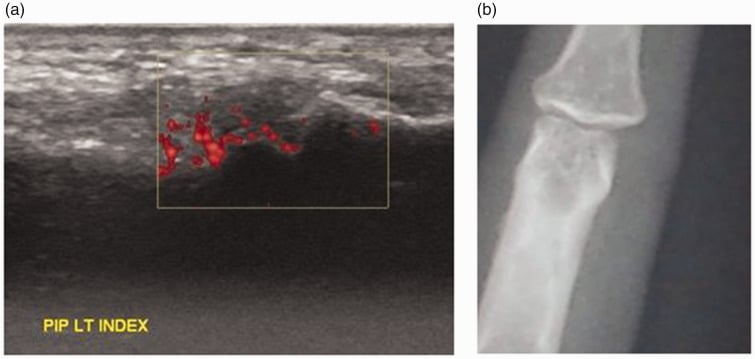 Longitudinal power Doppler ultrasound of second-PIP synovitis paired with a radiograph showing juxta-articular osteopenia.