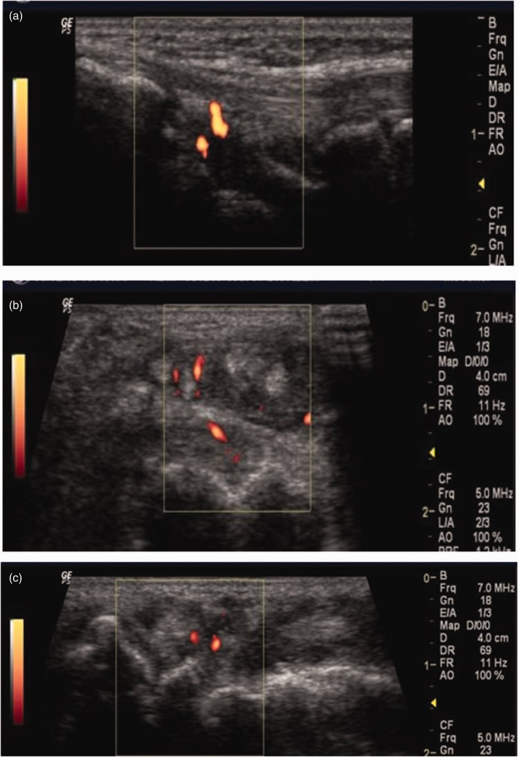 Longitudinal and transverse power Doppler ultrasound of the rheumatoid wrist showing synovitis, peritendinous inflammation and cortical erosions.