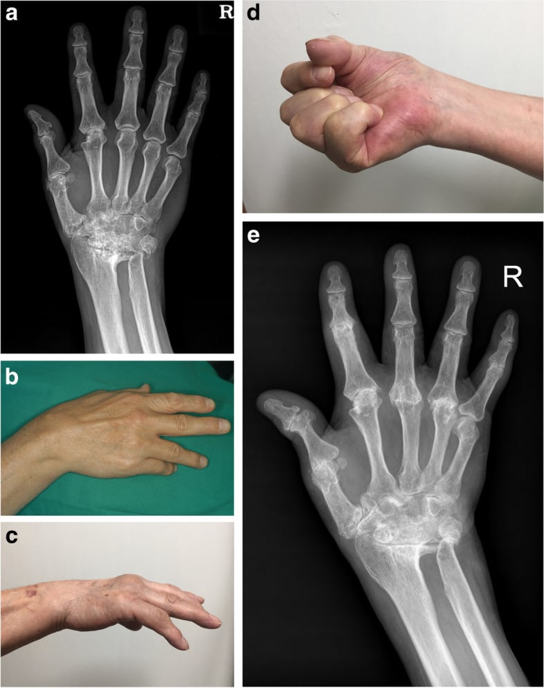 Radiographs and clinical photographs showing long-term recurrent little-finger extension loss after grafting for rheumatoid extensor tendon rupture.