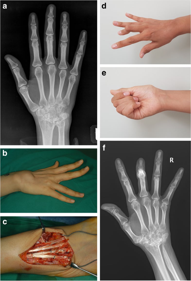 Preoperative radiograph and clinical views with intraoperative palmaris-longus graft reconstruction of rheumatoid ring- and little-finger extensor ruptures.
