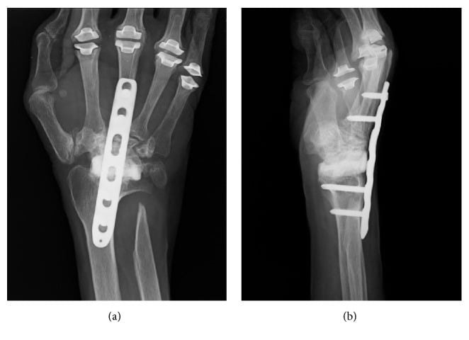 AP and lateral radiographs of total wrist arthrodesis using a dorsal locking plate.