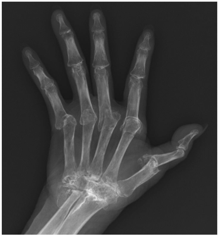 Hand radiograph showing rheumatoid arthritis mutilans with severe carpal and MCP bone loss, telescoping and ulnar deviation.