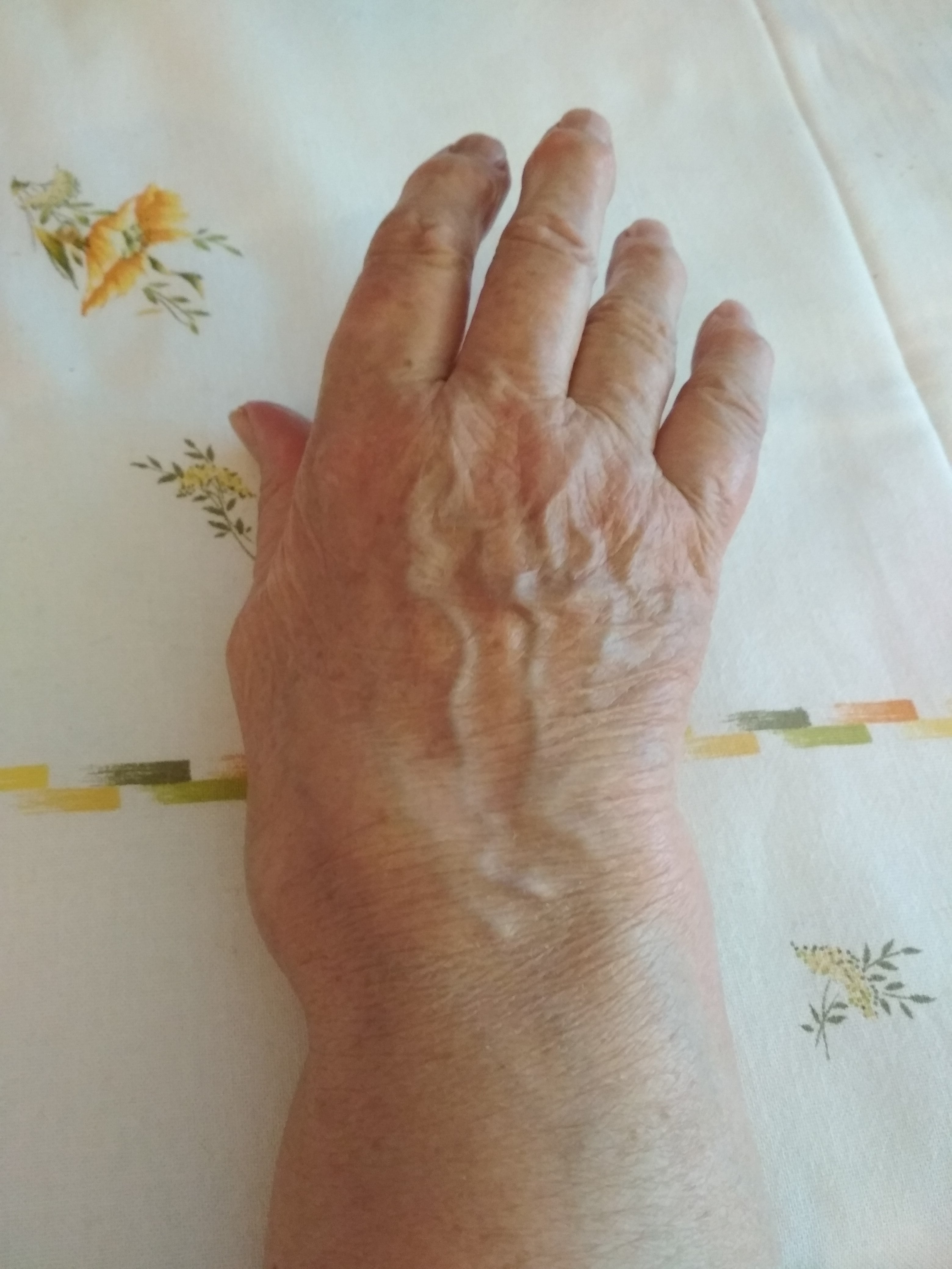 Clinical photograph of a hand in rheumatoid arthritis showing ulnar deviation of the fingers and metacarpophalangeal deformities.