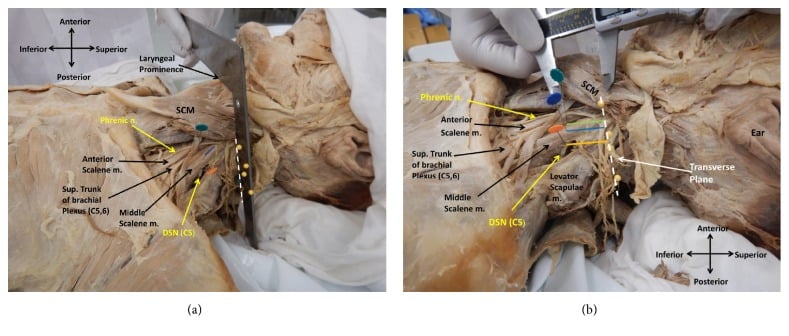 Cadaveric views showing the dorsal scapular nerve branching from C5 and piercing the middle scalene muscle, with surface reference measurements.