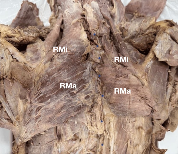 Posterior cadaveric dissection with trapezius reflected, exposing bilateral rhomboid minor and major muscles.