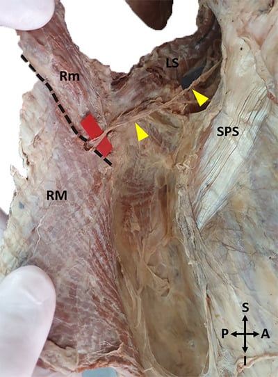 Cadaveric deep-surface view showing a dorsal scapular nerve branch entering rhomboid major from its superior border.