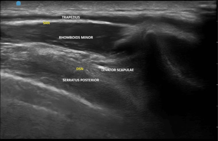 Ultrasound of the medial scapular region labelling trapezius, rhomboid minor, serratus posterior superior, spinal accessory nerve and dorsal scapular nerve.