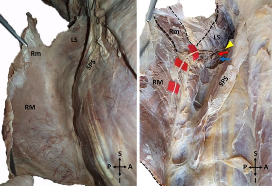 Cadaveric anterior-surface dissection tracing the dorsal scapular nerve, artery and vein beneath levator scapulae and the rhomboids.