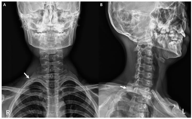 Anteroposterior and oblique cervical spine radiographs showing cortical irregularity of the first rib in a stress fracture
