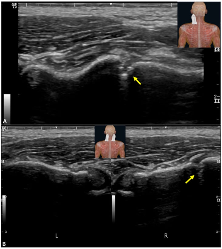 Musculoskeletal ultrasound showing a focal cortical discontinuity of the first rib with comparison to the contralateral side
