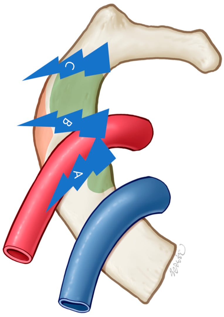 Anatomical schematic of first rib fracture classification locations