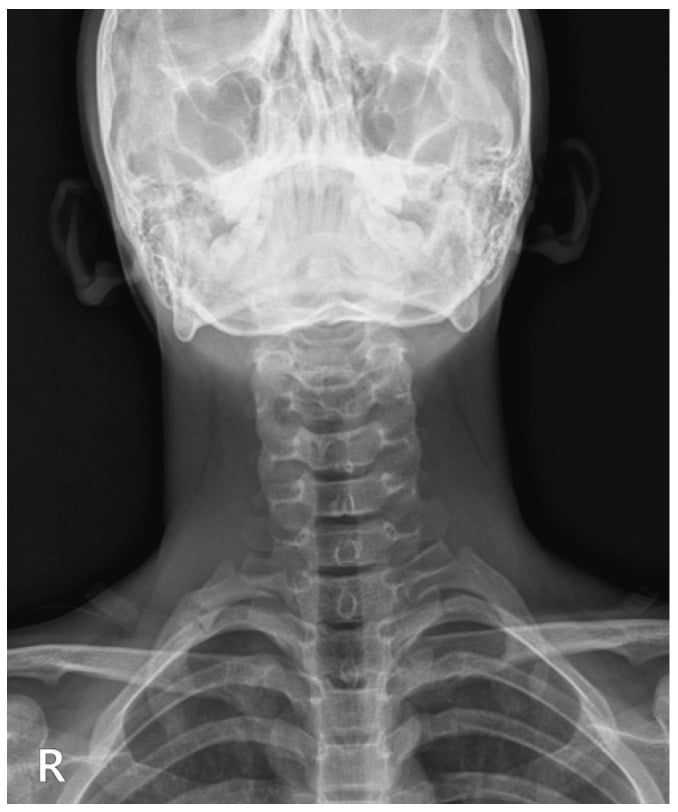 Follow-up AP radiograph demonstrating complete union and bridging callus of first rib fracture