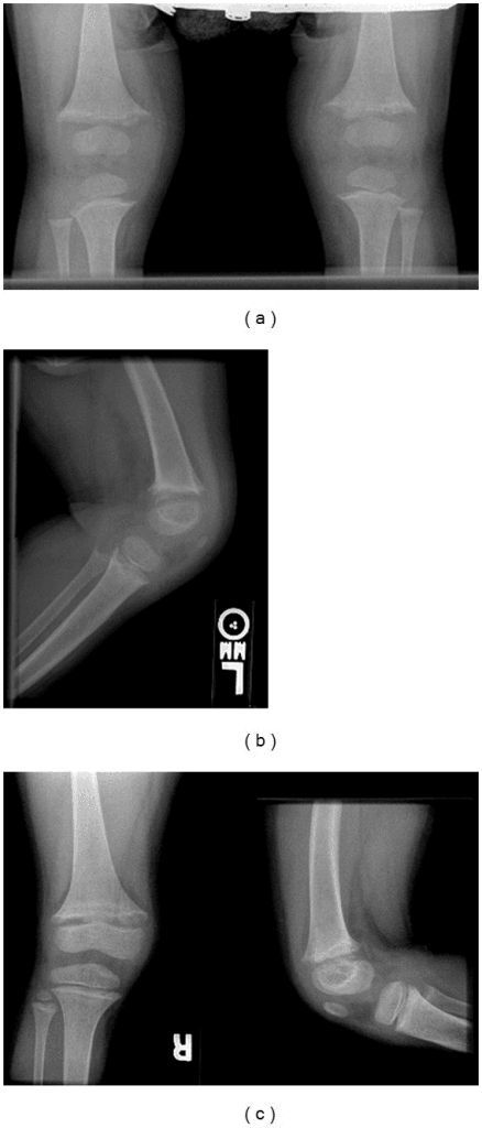 Radiographs of both knees showing rachitic metaphyseal change - irregularity, fraying and flaring of the distal femoral and proximal tibial metaphyses with widened growth plates.