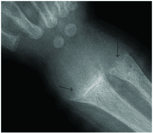 Radiograph of the wrist showing rachitic metaphyseal change - fraying, cupping and widening of the distal radial and ulnar metaphyses with loss of the provisional calcification zone.