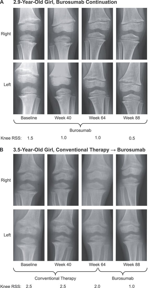 Right and left knee radiographs of two girls at baseline and weeks 40, 64 and 88, one on burosumab throughout and one switched from conventional therapy to burosumab, with printed knee rickets severity scores falling