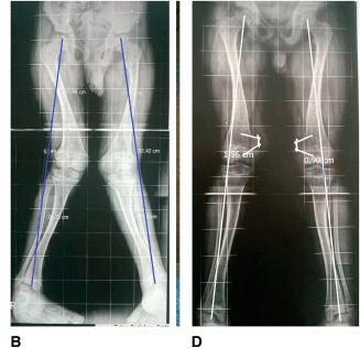 Standing alignment radiographs, panels B and D, before and after femoral guided growth for bilateral valgus caused by nutritional rickets, with the mechanical axes drawn