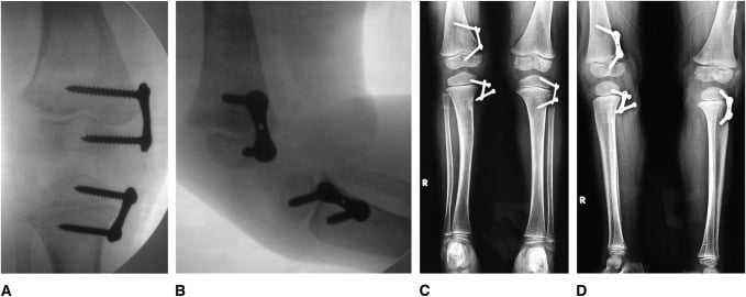 Serial radiographs showing guided-growth correction of severe windswept deformity