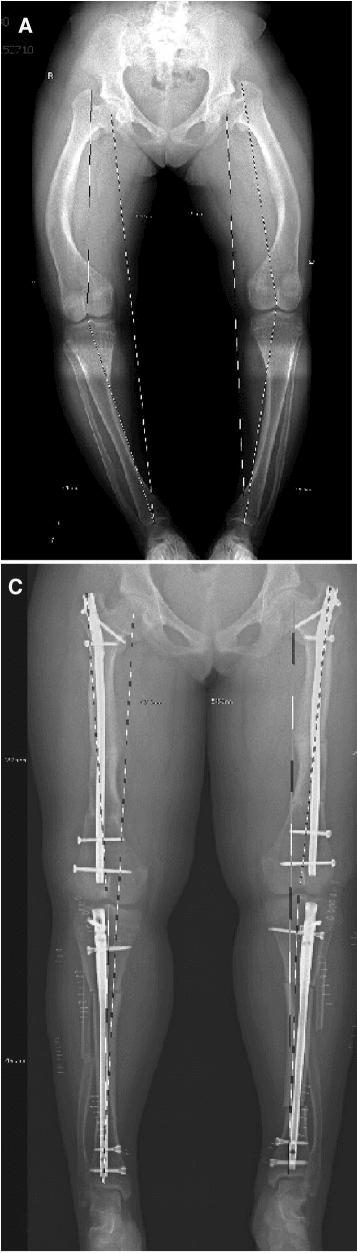 Standing radiographs, panels A and C, before and after multisegment osteotomy with interlocking intramedullary nails in both femora and both tibiae for hypophosphataemic rickets